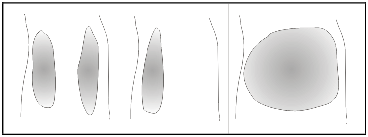 Figure 2.11. Different pond types. Left figure: Two ponds in the ruts. Middle figure: A single pond in the left rut creating asymmetrical friction. Right figure: A large pond across the whole road. 