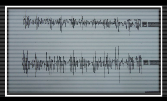 Figure 5.3EMG waveform for Essential Tremor