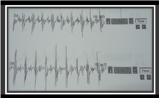 Figure 5.2.EMG waveform for Parkinson’s tremor